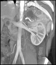 2 Left and 2 Right Renal Arteries - CTisus CT Scan