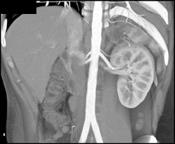 Multiple Renal Arteries - CTisus CT Scan