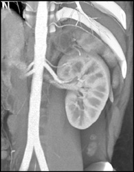 VRT Vs MIP - CTisus CT Scan