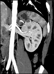 MIP Shows Renal Vein to Be Retroaortic, VRT Shows It Correctly - CTisus CT Scan