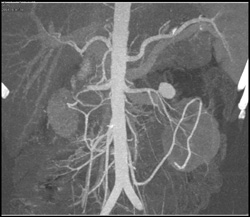 MIP of Pseudoaneurysm - CTisus CT Scan