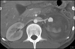 Pseudoaneurysm VRT Vs MIP - CTisus CT Scan