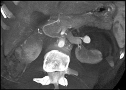 Pseudoaneurysm of Left Renal Artery - CTisus CT Scan