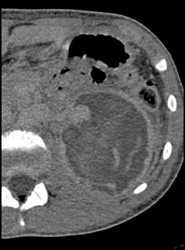 Pseudoaneurysm Missed on Late Phase Imaging - CTisus CT Scan