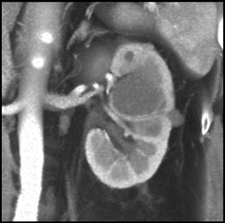 Left Renal Abscess - CTisus CT Scan