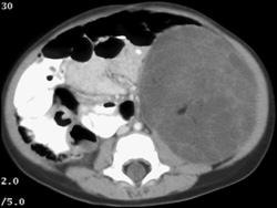 Wilms Tumor With Fat - CTisus CT Scan