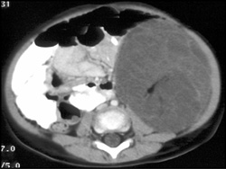 Wilms Tumor - CTisus CT Scan