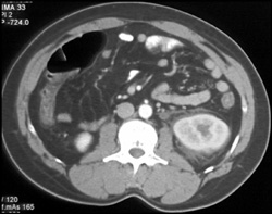 Obstructed Left Kidney With Urine Around Kidney - CTisus CT Scan