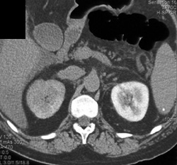 Delayed Function of Right Kidney - CTisus CT Scan