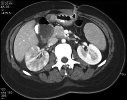 Acute Pyelonephritis on Right - CTisus CT Scan