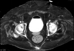 Thickened Bladder Wall - CTisus CT Scan