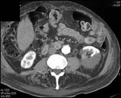 Renal Infarct - CTisus CT Scan