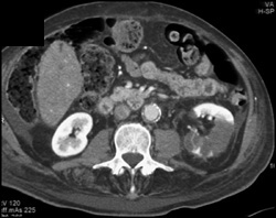 Renal Infarct - CTisus CT Scan