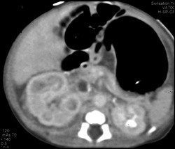 Renal Vein Thrombosis in A Neonate - CTisus CT Scan