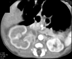 Right Renal Vein Thrombosis - CTisus CT Scan