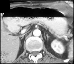 Clot in SMA - CTisus CT Scan