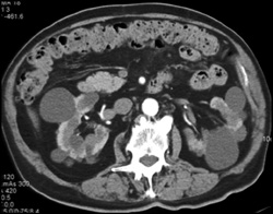 Pck Kidneys - CTisus CT Scan