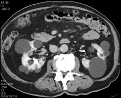 Hemorrhagic Renal Cyst - CTisus CT Scan