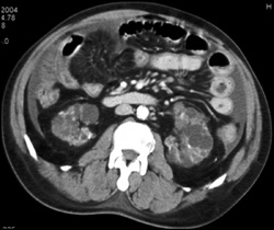 Pck With Carcinoma - CTisus CT Scan