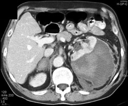 Subcapsular Bleed - CTisus CT Scan