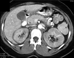 Acute Pyelonephritis - CTisus CT Scan