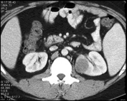 Infected Renal Cyst - CTisus CT Scan