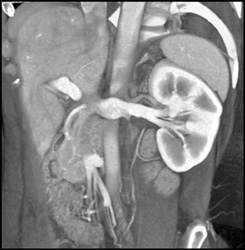 Normal Left Renal Veins - CTisus CT Scan