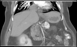 Metastatic Renal Cell Carcinoma to Pancreas - CTisus CT Scan