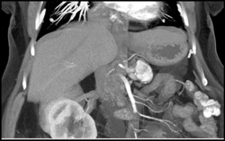 Metastatic Renal Cancer to Pancreas - CTisus CT Scan