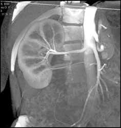 Normal Renal Arteries - CTisus CT Scan