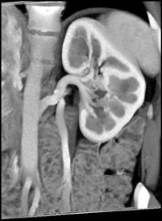 Prominent Left Gonadal Vein - CTisus CT Scan