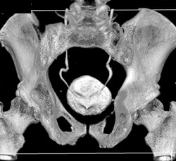 Normal Ureterovesical Junction (UVJ) in Bladder - CTisus CT Scan