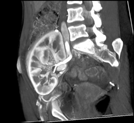 Transplant Kidney - CTisus CT Scan