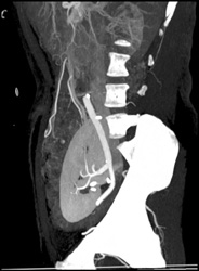 Transplant Kidney With Renal Artery Off Iliac Artery - CTisus CT Scan