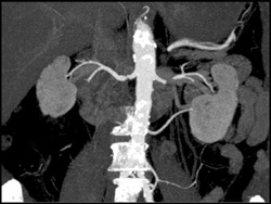 2 Left Renal Arteries With MIP/VRT - CTisus CT Scan
