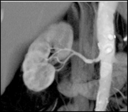 Stenosis of Right Renal Artery - CTisus CT Scan