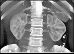 1 Cm Left Renal Cell Carcinoma - CTisus CT Scan