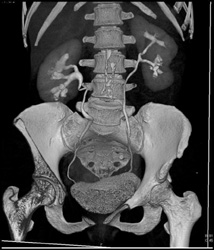 Chronic Pyelonephritis Left Kidney - CTisus CT Scan