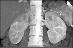 Subtle 2cm Left Renal Cell Carcinoma - CTisus CT Scan