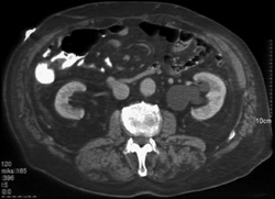 Dilated Ureter Extends Into the Inguinal Ring - CTisus CT Scan