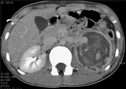 Post Traumatic Renal Hemorrhage With Pseudoaneurysm. Key Is Arterial Phase Imaging - CTisus CT Scan