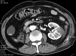 Renal Cell Carcinoma - CTisus CT Scan