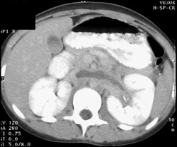 Renal Vein Thrombus - CTisus CT Scan