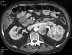 Renal Cell Carcinoma Invades the Left Renal Vein - CTisus CT Scan