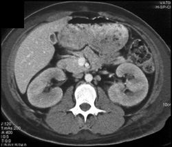 Acute Pyelonephritis - CTisus CT Scan