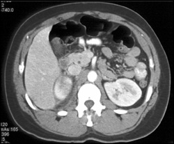 Acute Pyelonephritis Right Kidney - CTisus CT Scan