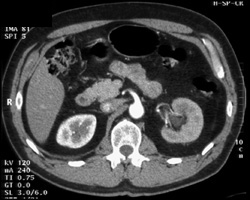 Delayed Function Left Kidney - CTisus CT Scan