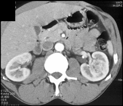 Subtle Right Renal Cell Carcinoma - CTisus CT Scan