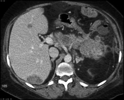 Pancreatic Cancer With Implants on Liver and Left Renal Artery and Vein - CTisus CT Scan