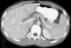 Von Hippel-Lindau syndrome (VHL) With Cystic Renal Cell Carcinoma and Pancreatic Cyst - CTisus CT Scan